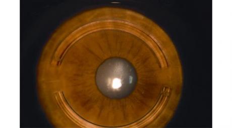 Treatment of Keratoconus  with corneal rings © 2019 American Academy of Ophthalmology